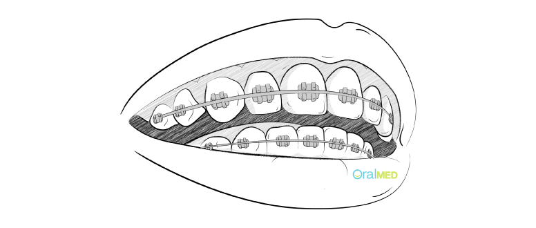 Aparelho dentário autoligado Damon System