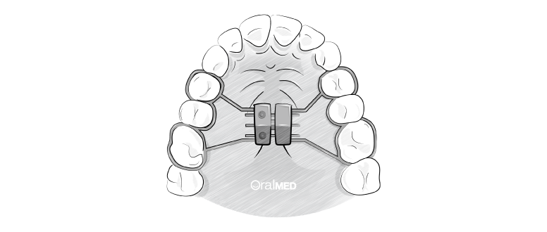 ​​Aparelho dentário expansor palatino