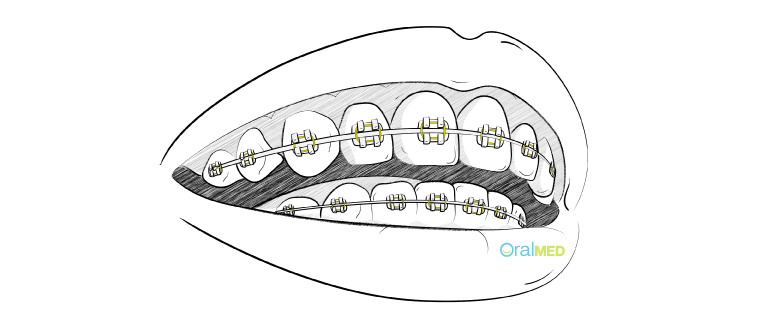 Aparelho dentário fixo convencional