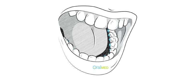 Aparelho dentário lingual