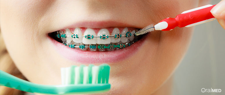 Aparelho dentário: porque é importante para as crianças?