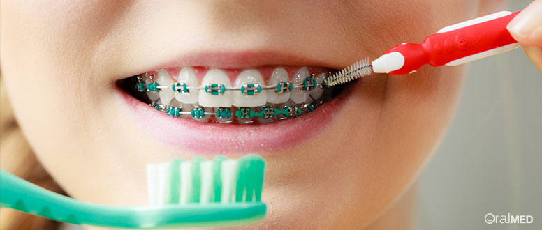 Aparelho dentário: porque é importante para as crianças?