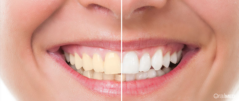 Em que consiste um branqueamento dentario?