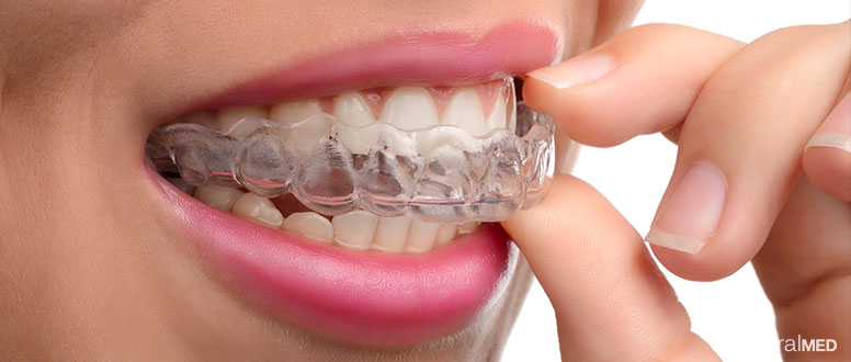 Bruxismo: uma goteira é a melhor forma de evitar os danos nos seus dentes.