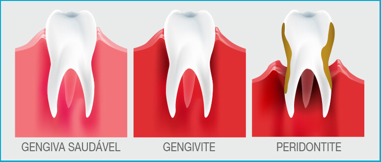Doenças nas gengivas: da gengivite à periodontite