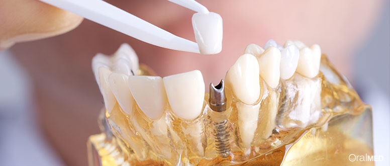 Implante dentário: uma solução para substituir dentes perdidos.