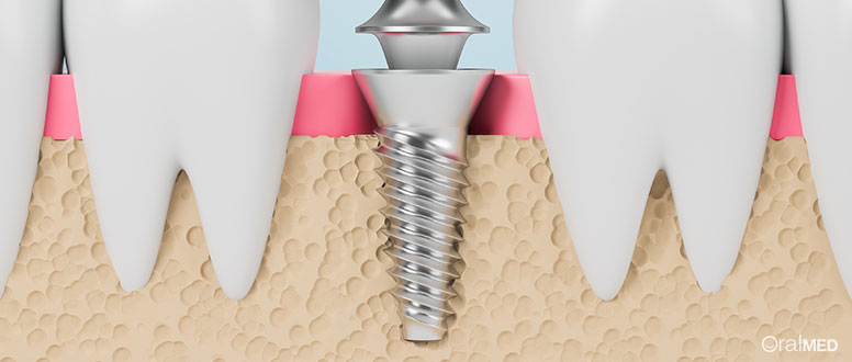 Os implantes dentários substituem as raízes dos dentes.