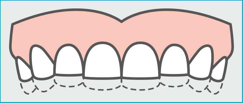 Ranger os dentes