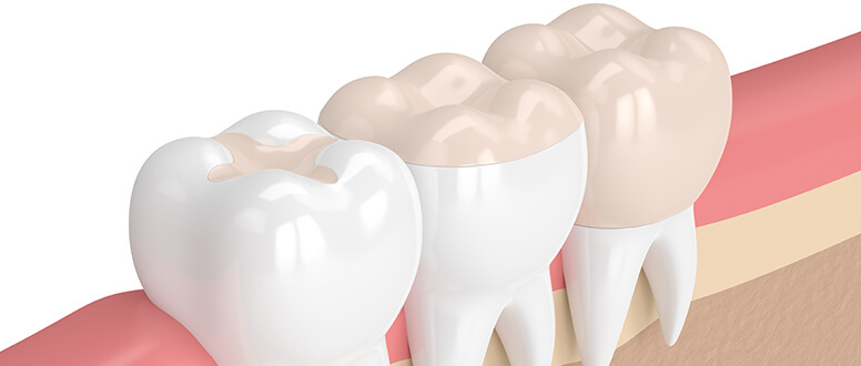 Restauração dos dentes: a cor fica igual?