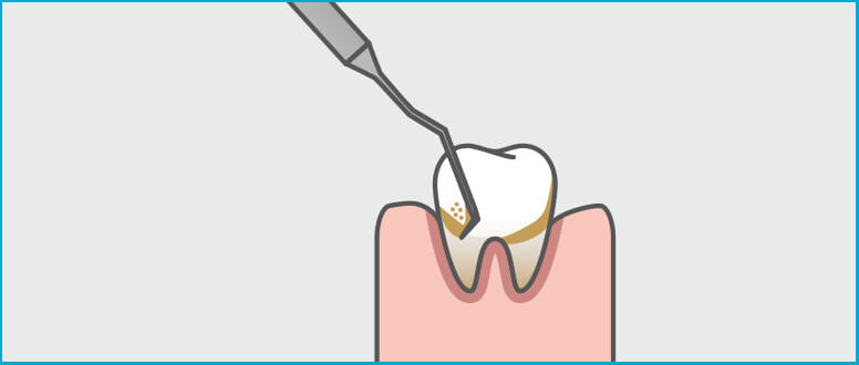 Tártaro nos dentes: o que é e como se deve remover?