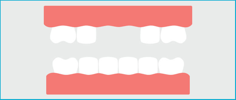 Tem falta de dentes? Substitua-os rapidamente