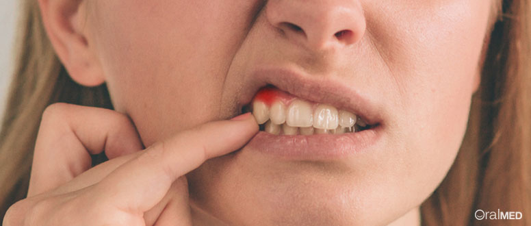Tratamento da periodontite: o que são bolsas periodontais?