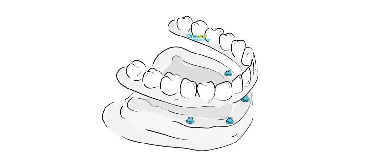 Proteses dentarias: Protese dentaria fixa total ou all-on-4, também conhecida como all-on-four