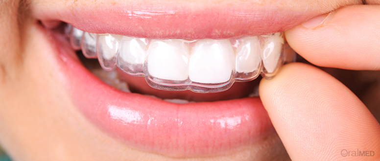 Aparelho dentário invisível: o que é e como funciona?