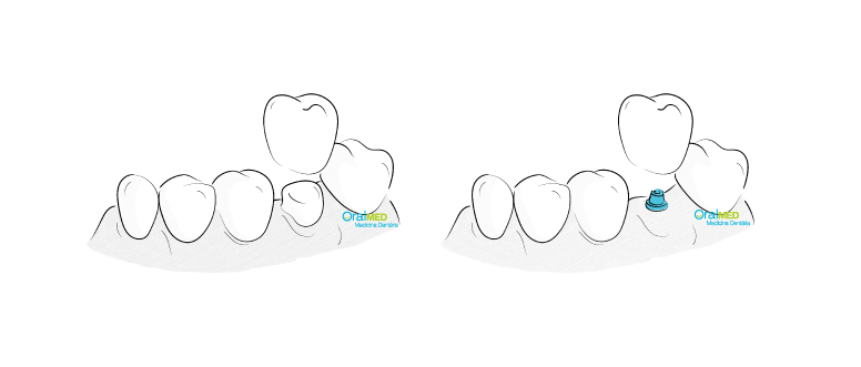 Proteses dentarias: Coroa unitaria sobre dente ou implante