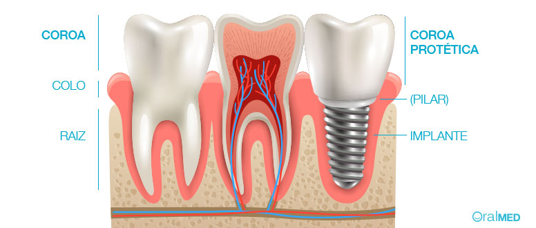 Coroas dentárias