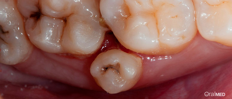 Dentes a mais são dentes supranumerarios