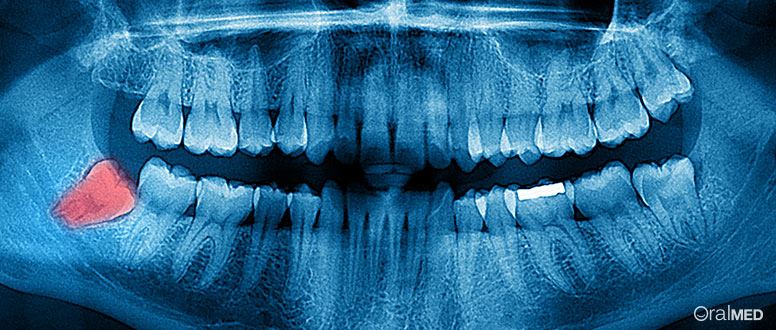 Os mal-amados dentes do siso.