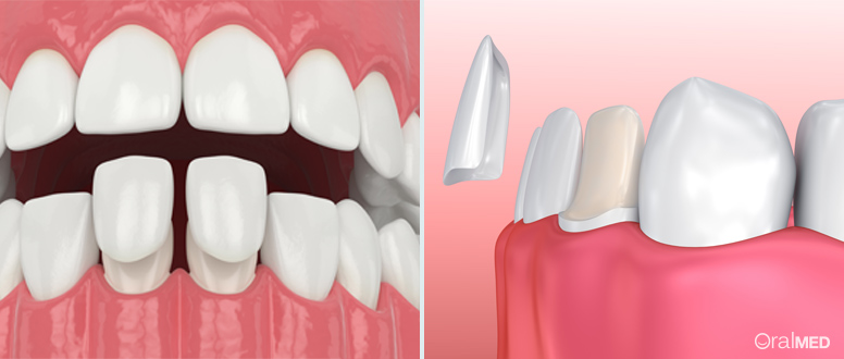 As facetas dentárias estragam os dentes?
