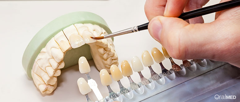 As facetas dentárias devem receber os mesmos cuidados do que os nossos dentes naturais.
