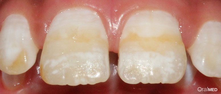 O que é a fluorose dentária?