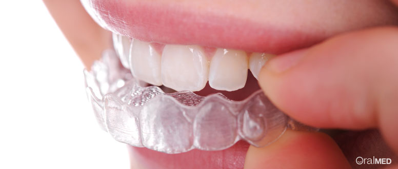 Ortodontia: hoje em dia, soluções como o Invisalign permitem eliminar os constrangimentos dos arames.