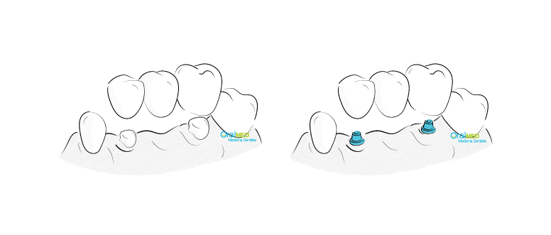 Coroas Dentárias: prótese fixa.