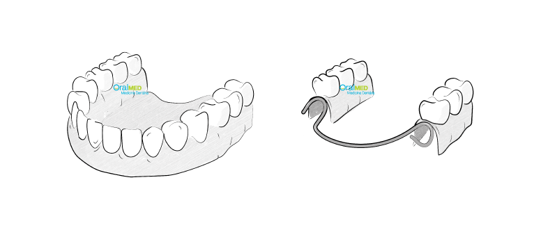 Proteses dentarias: Protese dentaria removível acrílica e esquelética