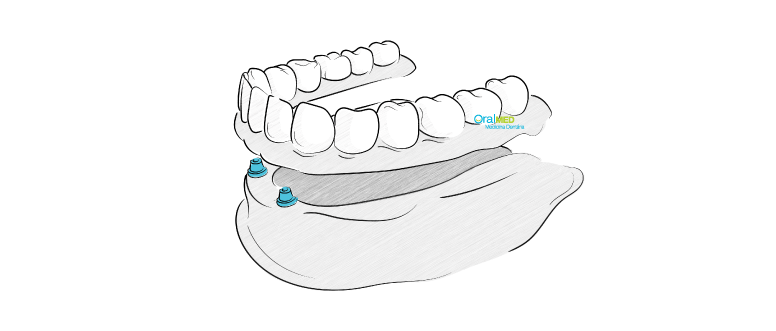 Próteses dentárias: Prótese dentária semifixa ou sobredentatura