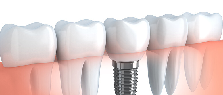 rejeição do implante dentário