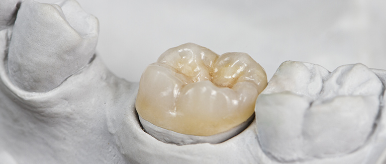 restaurações dentárias