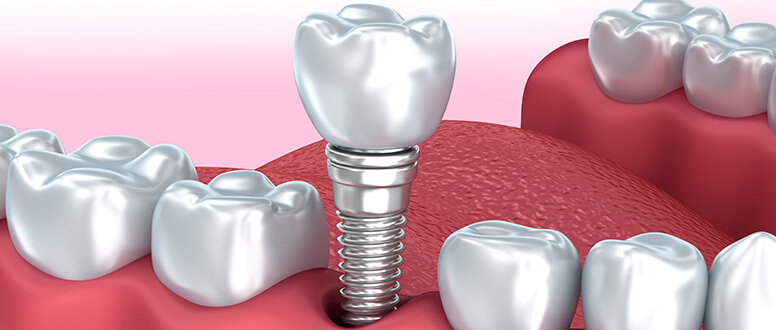 Implantes dentários: a descoberta do titânio