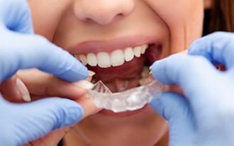 Aparelho invisível: a solução ideal para muitos Pacientes.