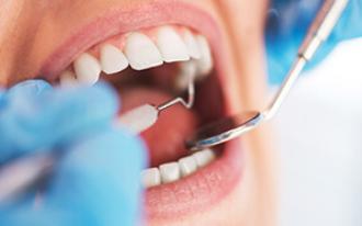 A acumulação de tártaro nos dentes pode originar vários problemas de saúde.