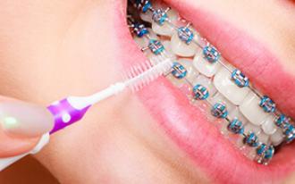 lavar os dentes com aparelho dentário