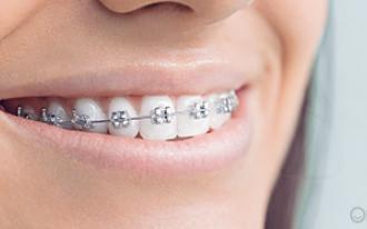 Aparelho para os dentes: o que muda no dia-a-dia?