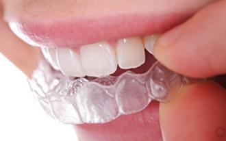 Aparelho dentário invisível: o que é e como funciona?