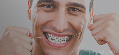 lavar os dentes com aparelho dentário