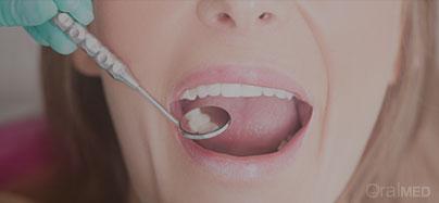 Tártaro nos dentes: saiba o que deve fazer.