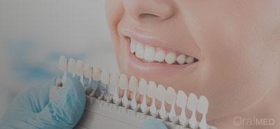 Facetas dentárias
